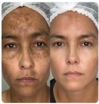 Antes e depois — Maria, 45 anos