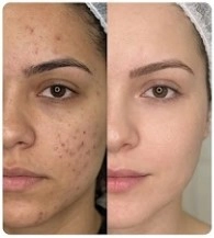 Antes e depois — Ana, 38 anos